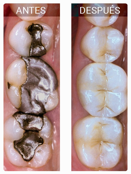 Empastes Dentales Antes y Después