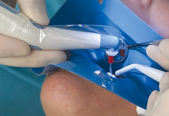 Endodoncia Madrid Clinica Dental Betel Endodoncia Madrid Clinica Dental Betel